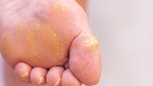 Why are corns formed on the feet?