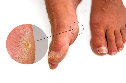 Foot Corn Removal Walkthrough by Podiatrist