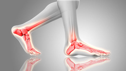 Heel Pain Solutions: How to Treat Plantar Fasciitis Effectively