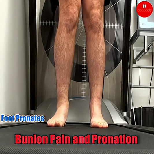 Feeling bunion pain? It might be over-pronation to blame! Discover tips to ease the ache and take