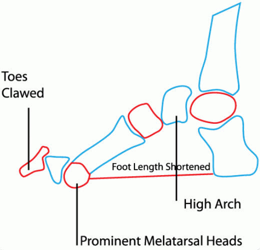 Expert Insights: The Best Solutions for Claw Toes in Work Boots