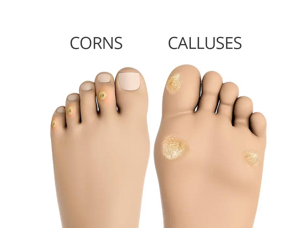 Podiatrist Removes 2nd Toe Callus | Watch the Satisfying Procedure