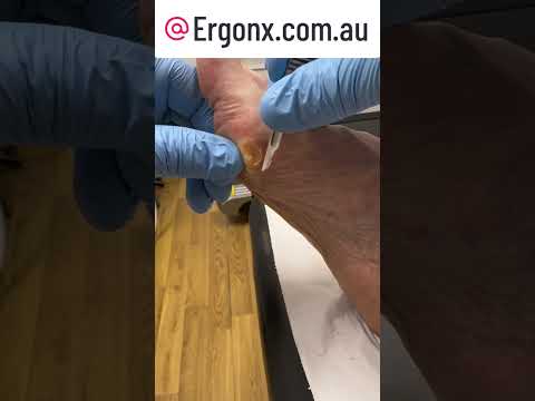Satisfying Thick Callus Removal with Scalpel Debridement Podiatry Clinic #Podiatry #CallusRemoval