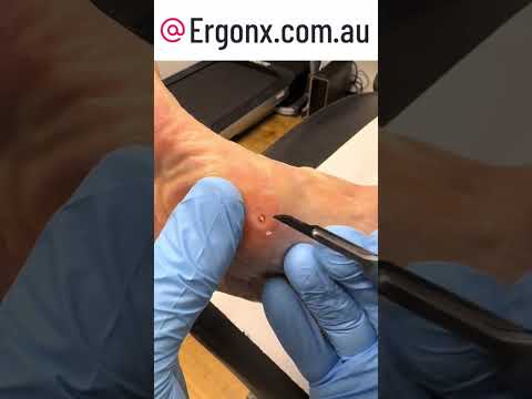 Callus Removal Revealing a Plantar Wart Explained