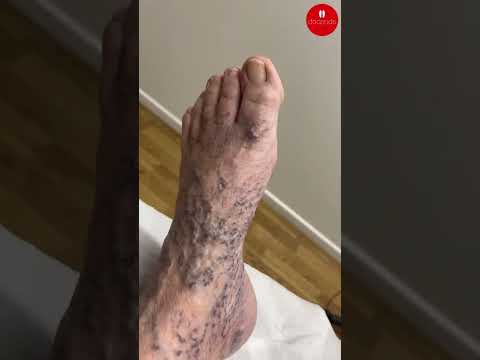 ✨ Tired of hiding those varicose veins? Transform your legs with our proven tips and regain your