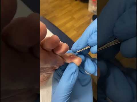 🌽👣 Watch the most satisfying corn removal by our expert podiatrist! Get ready for the ultimate toe