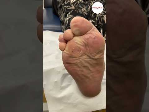 Severe Corn Removal: What Happens at the Podiatrist