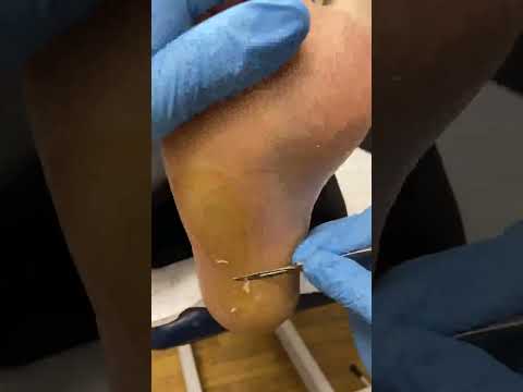 Watch this epic callus transformation! ✨👣 Satisfying shave off as smooth as butter