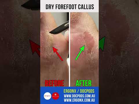 Say Goodbye to Dry Callus: Forefoot Transformation by Podiatrist #CallusRemoval #PodiatryCare