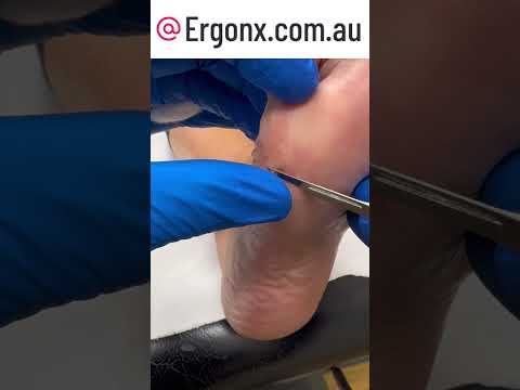 Satisfying Corn Removal by Top Australian Podiatrist #FootCare #Podiatry
