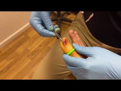 Say goodbye to painful ingrown nails! Watch this satisfying and informative removal process