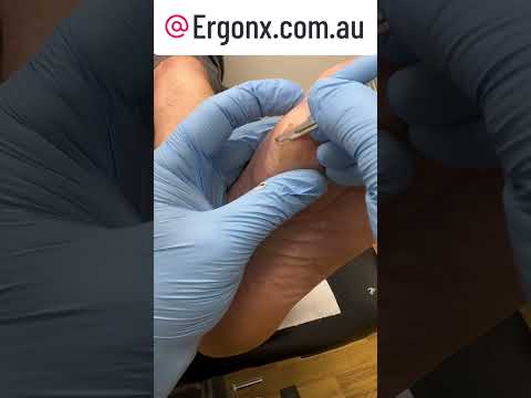 Satisfying Callus Removal by Podiatrist - Hard Skin Cutting #Podiatry #FootCare
