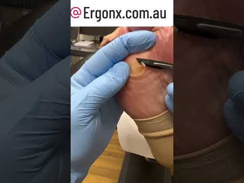 Podiatrist's Guide to Pain-Free Corn & Callus Removal #FootCare #Podiatry