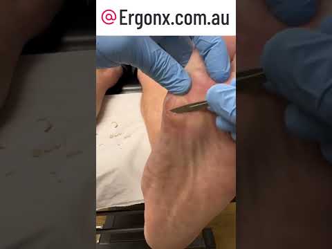 Satisfying Thick Callus Removal with Scalpel in Podiatry Clinic #Podiatry #CallusRemoval
