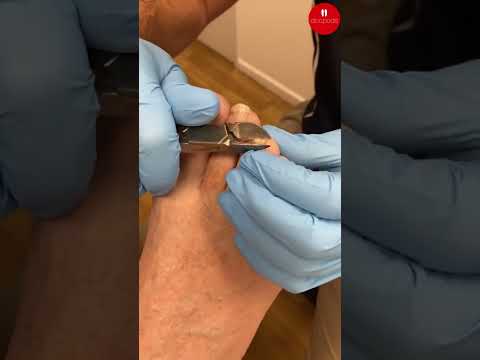 Transform your nails with a fungal nail trim! Say goodbye to discomfort and hello to healthy nails