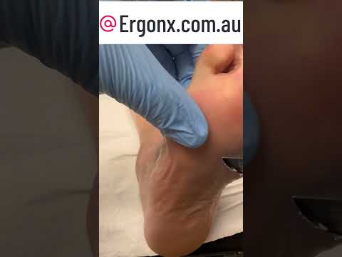 Ultimate Callus Transformation Watch Foot Smoothing Magic Footcare #Satisfying #FootCare