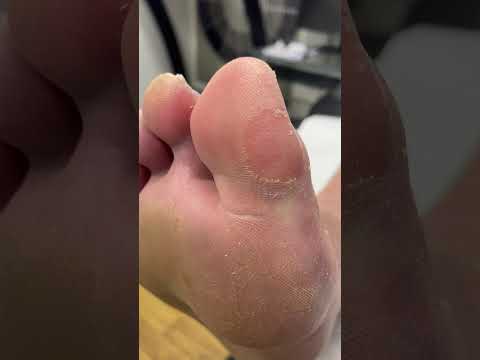 Transform your feet and get ready for sandal season! Watch this satisfying big toe hard skin removal