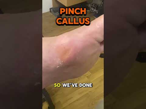 Pinch Callus (Tyloma) Removal – Why These Hurt So Much This video shows our podiatrist carefully