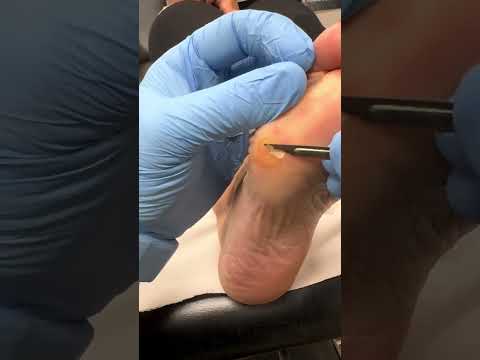 Incredible Corn Removal Relief: Podiatrist Helps Runner Recover Fast #FootCare #Podiatrist