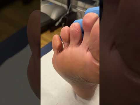 Transform your feet and step into comfort! 🌟 Watch as this podiatrist works wonders removing a