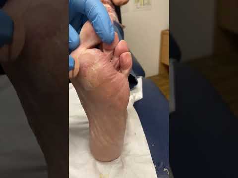 Transforming rough to smooth! 🌟 Say goodbye to calluses and hello to soft feet