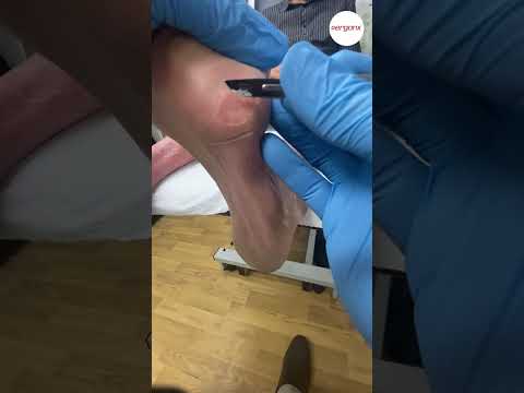Say Goodbye to Foot Pain Watch This Corn Removal by a Podiatrist #FootCare #Podiatry