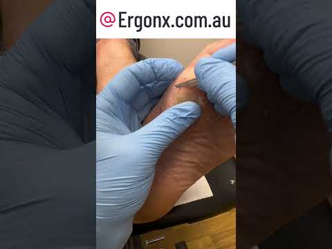 Ultimate Satisfying Thick Callus Removal by Podiatrist with Scalpel #Podiatry #Satisfied