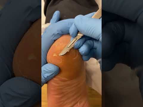 Transform your feet from rough to smooth! 🚀 Watch this satisfying heel callus removal for a fresh,