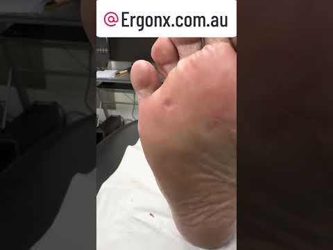 Aussie Podiatrist Tackles Tough Corns & Calluses! #FootCare #Podiatry