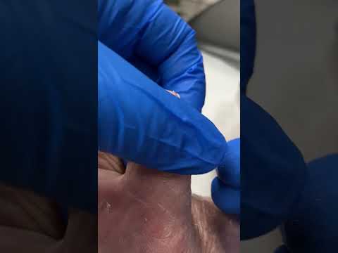 Satisfying Big Toe Callus Removal Cutting Thick Dry Skin #FootCare #CallusRemoval