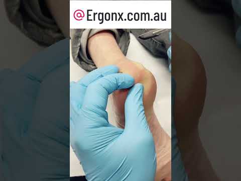 Ultimate Cracked Heel Callus Removal at Podiatry Clinic #CallusCare #FootHealth