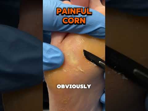 This is a deep plantar forefoot corn