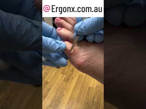 Expert Podiatrist Removes Corn & Callus from 5th Toe #FootCare #Podiatry