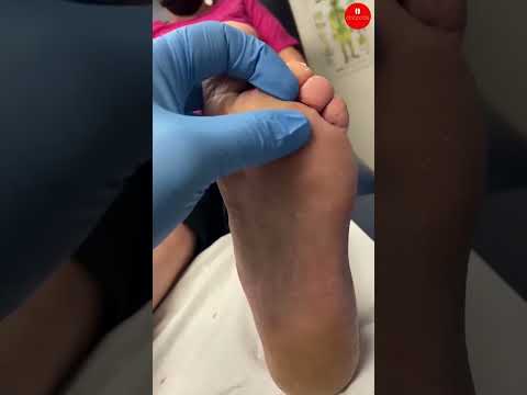 Callus Formation Over a Neuroma Surgery Scar