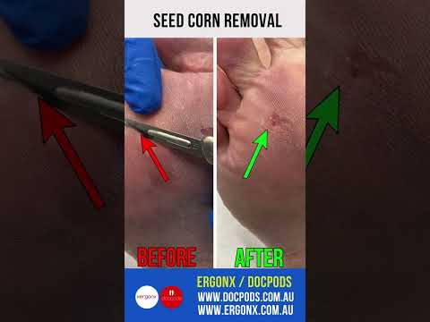 Instant Pain Relief: Seed Corn Removal from Foot #FootCare #PainRelief