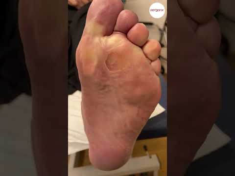 Forefoot Callus and Corn Removal by a Podiatrist: Video Guide