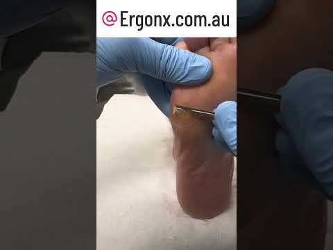 Satisfying Foot Transformation Corn & Callus Removal with Scalpel #Podiatry #FootCare