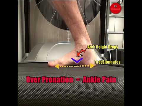 How Overpronation May Affect Ankles and Joints