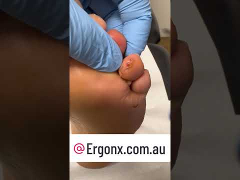 Satisfying Callus & Blood Blister Removal by Podiatrist #FootCare #ASMR