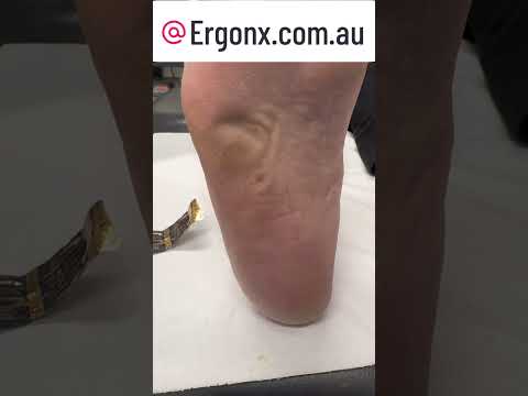 Satisfying Slow-Mo Corn Removal by Skilled Podiatrist #FootCare #SatisfyingRemovals