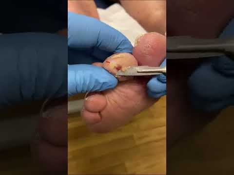 Experience the miracle of healing! 🦶✨ Witness a podiatrist in action transforming diabetic ulcers