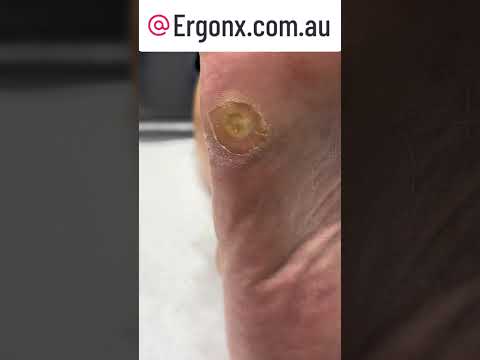 Epic Corn & Callus Removal by Podiatrist: Satisfying Transformation #Podiatry #FootCare