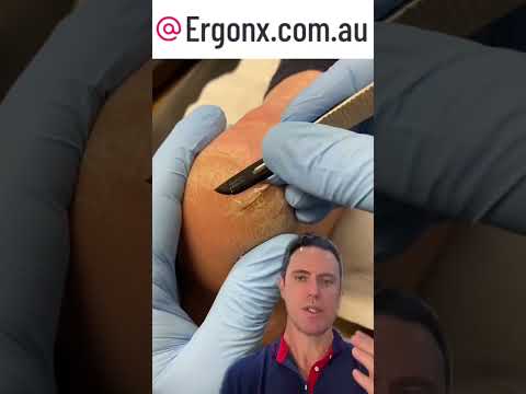 Podiatrist's Guide to Cracked Heels Fix #FootCare #PodiatristTips