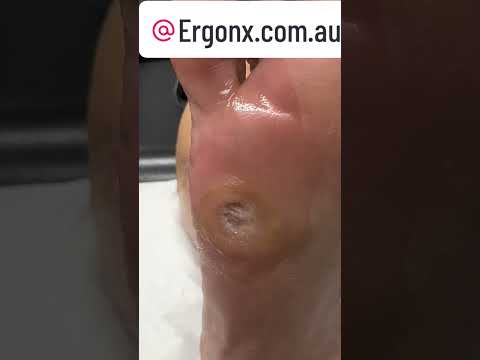 Satisfying Corn & Callus Removal by Podiatrist - Watch the Transformation! #FootCare #Podiatry