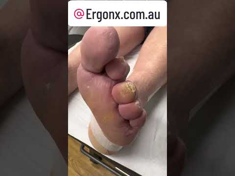 Satisfying Callus Removal on a Toe by Expert Podiatrist #OddlySatisfying #FootCare