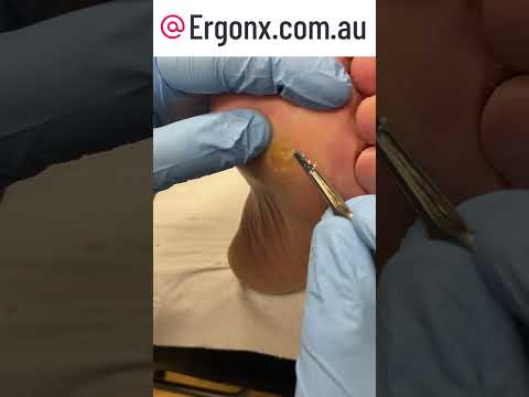Satisfying Corn Removal by Podiatrist: Watch Foot Transform #FootCare #Podiatry