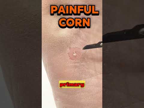 Painful midfoot corn removal 👣 In today’s consult, our podiatrist is carefully removing a painful