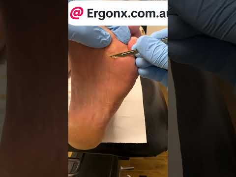 Ultimate Corn & Callus Removal with Scalpel | Podiatry Clinic Foot Care #Podiatry #FootHealth