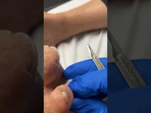 Podiatrist's Secret to Callus-Free Feet Revealed #FootCare #Podiatry