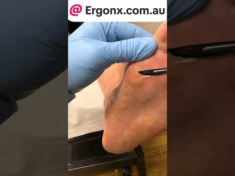 Foot Callus Removal by a Podiatrist Explained
